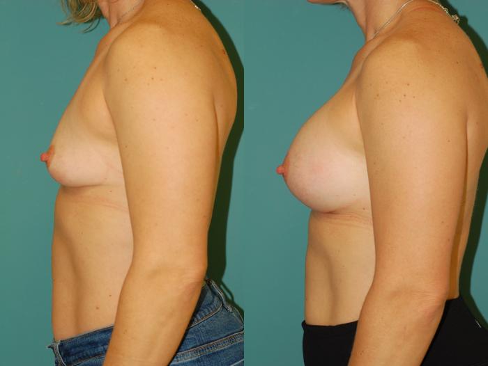 Before & After Breast Augmentation Case 52 View #3 View in Ellicott City, MD