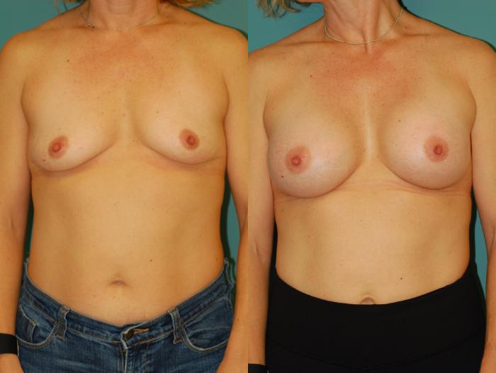 Before & After Breast Augmentation Case 52 View #4 View in Ellicott City, MD