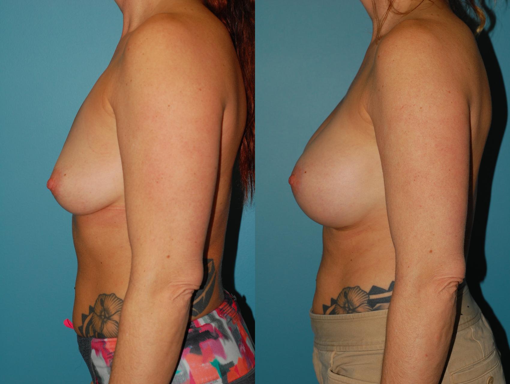 Before & After Breast Augmentation Case 58 View #2 View in Ellicott City, MD