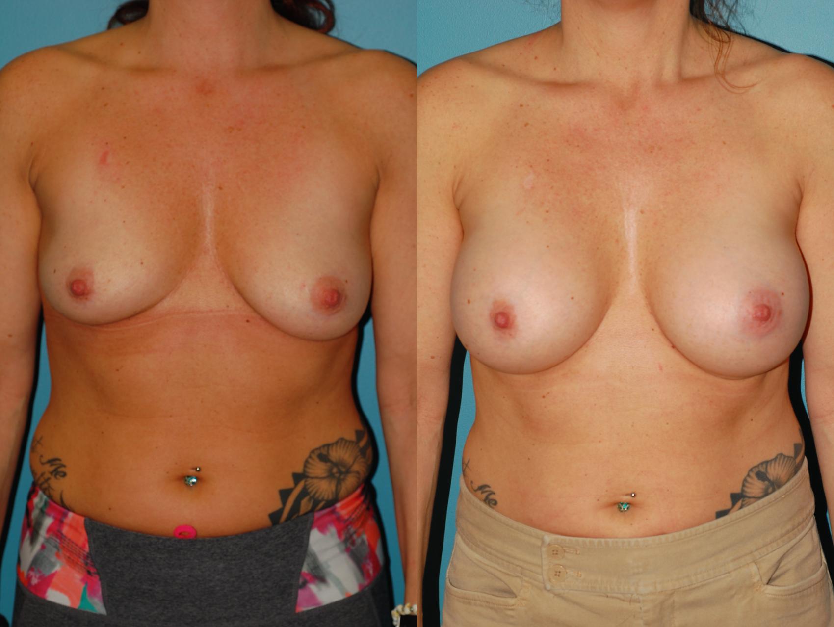 Before & After Breast Augmentation Case 58 View #3 View in Ellicott City, MD