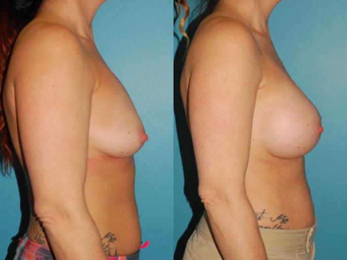 Before & After Breast Augmentation Case 58 View #5 View in Ellicott City, MD
