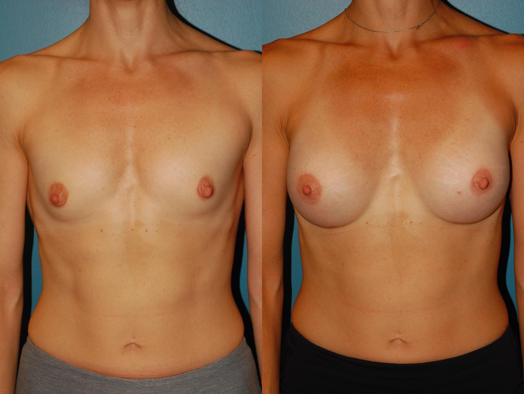 Before & After Breast Augmentation Case 66 View #1 View in Ellicott City, MD