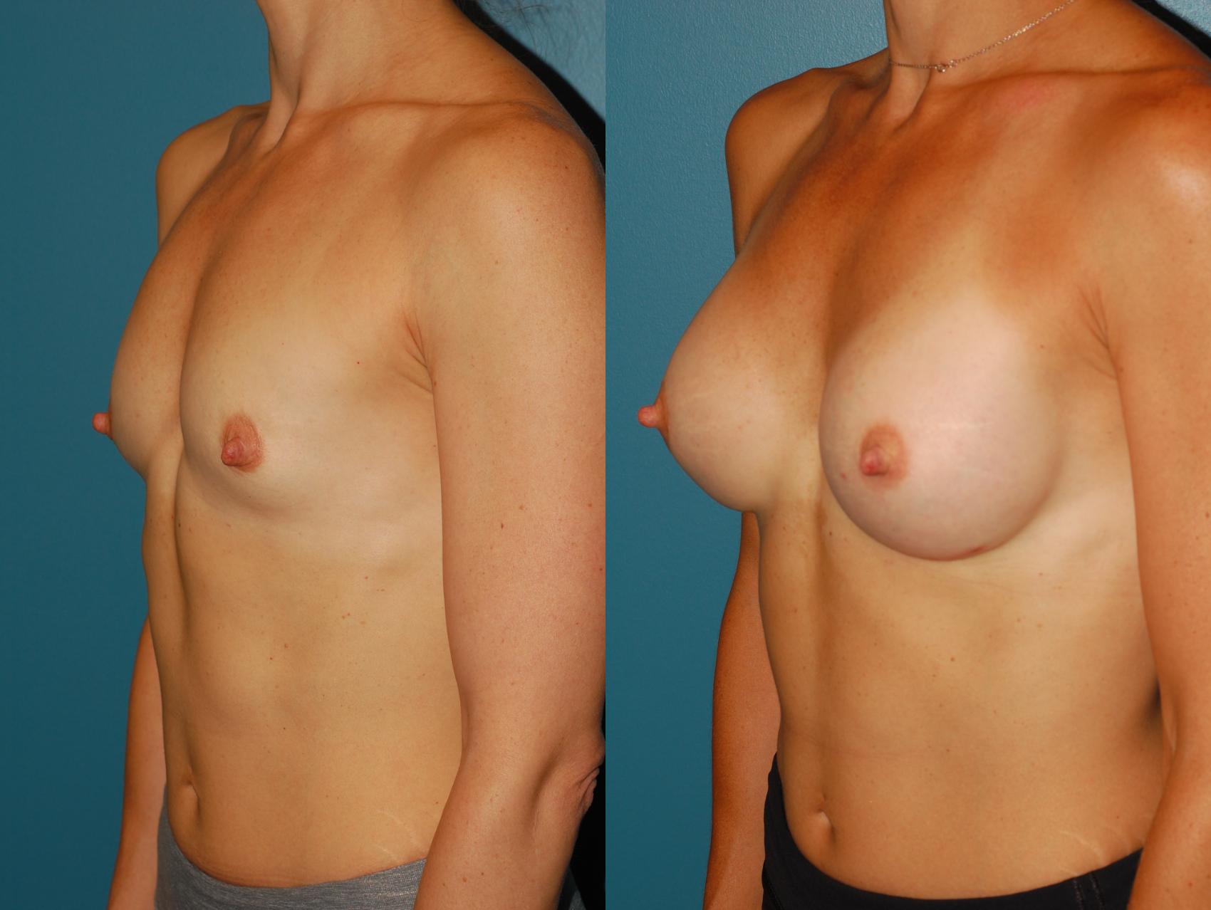 Before & After Breast Augmentation Case 66 View #2 View in Ellicott City, MD