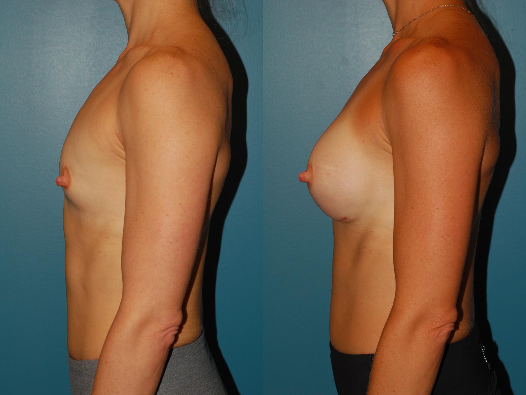 Before & After Breast Augmentation Case 66 View #3 View in Ellicott City, MD