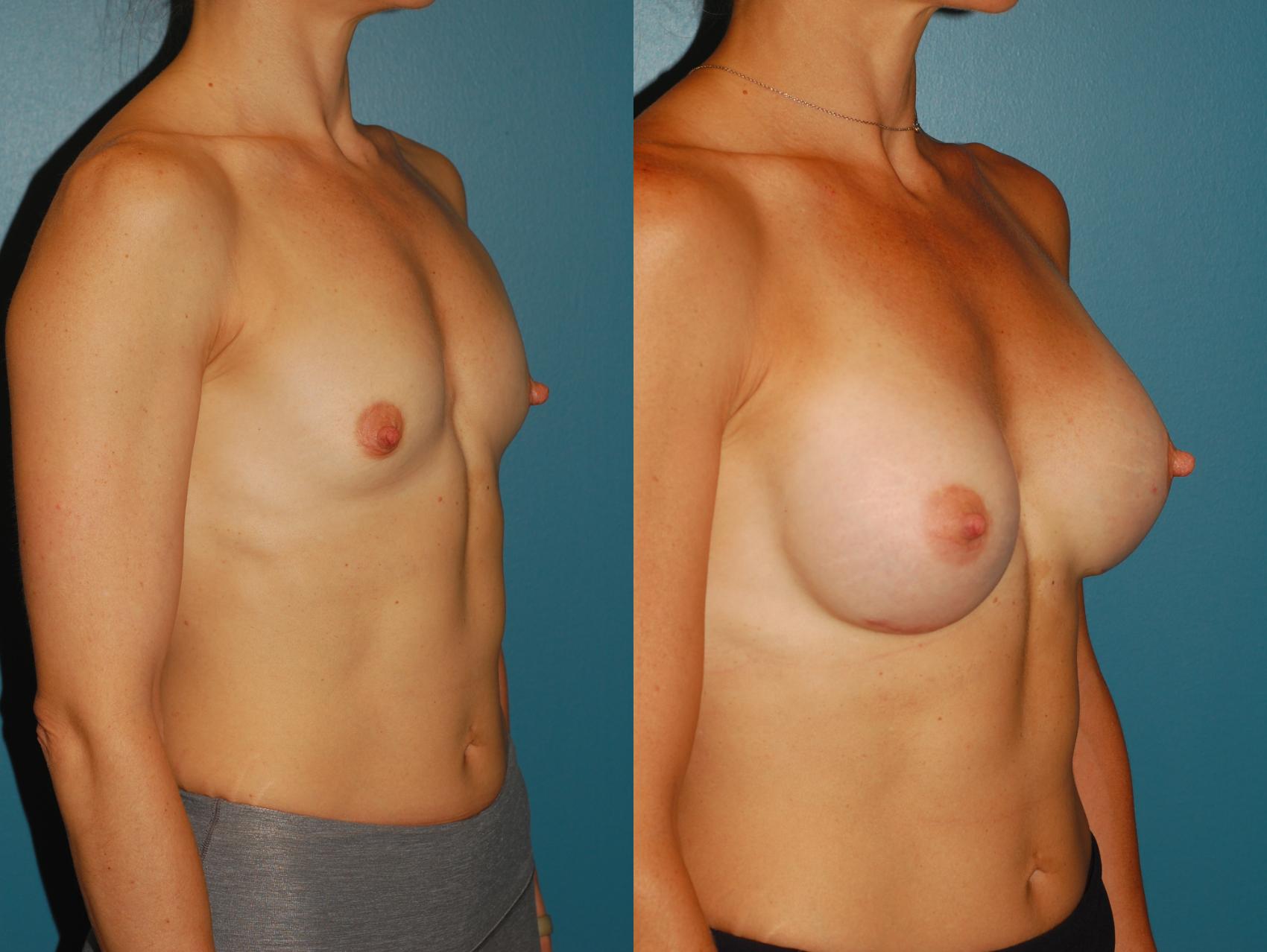 Before & After Breast Augmentation Case 66 View #4 View in Ellicott City, MD