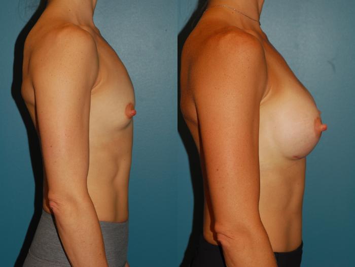 Before & After Breast Augmentation Case 66 View #5 View in Ellicott City, MD