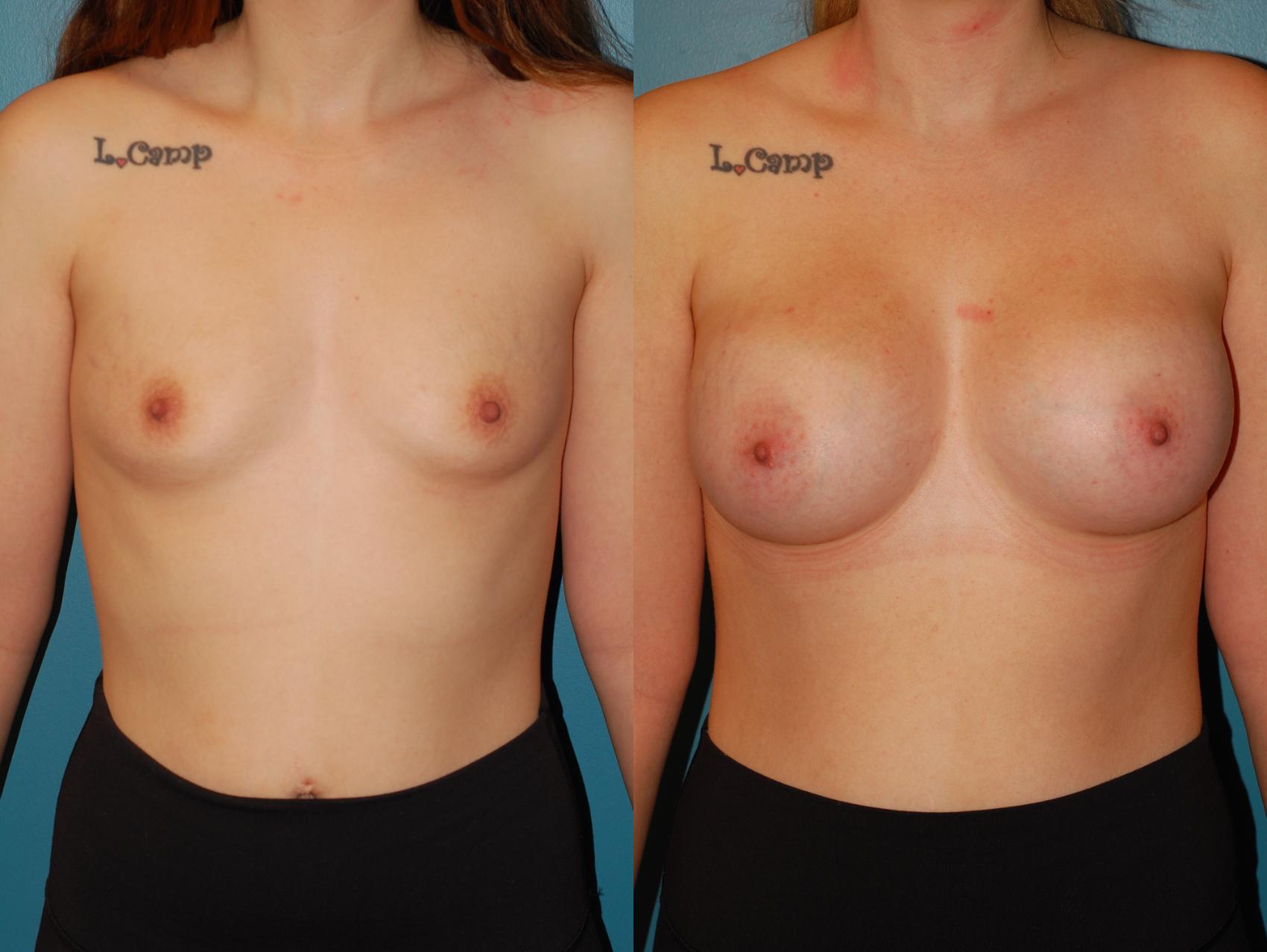 Before & After Breast Augmentation Case 68 View #1 View in Ellicott City, MD