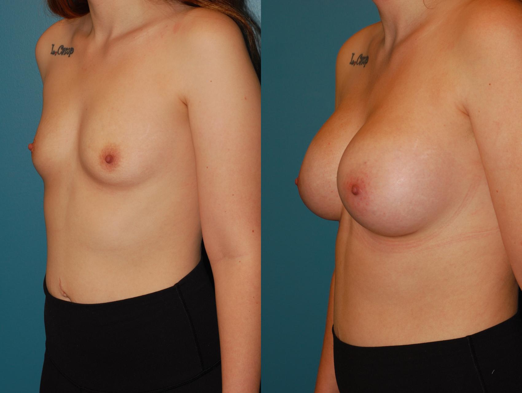 Before & After Breast Augmentation Case 68 View #2 View in Ellicott City, MD
