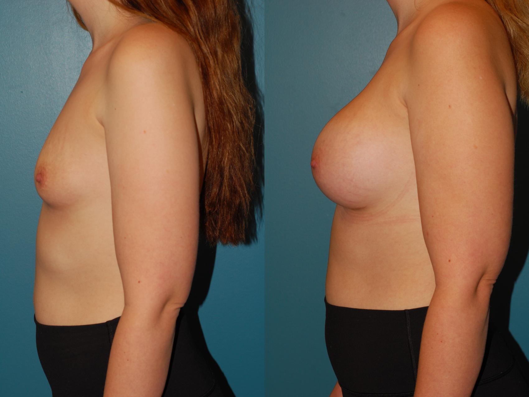Before & After Breast Augmentation Case 68 View #3 View in Ellicott City, MD