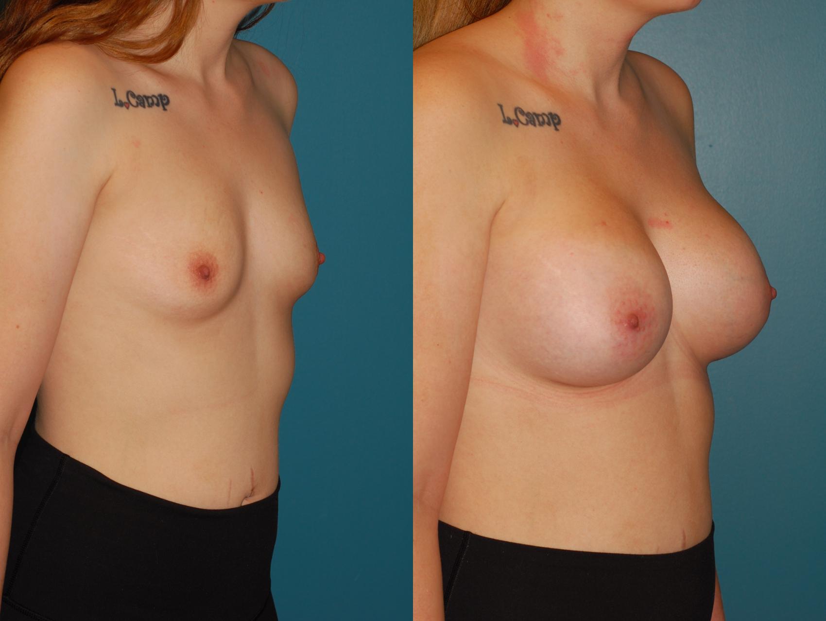 Before & After Breast Augmentation Case 68 View #4 View in Ellicott City, MD