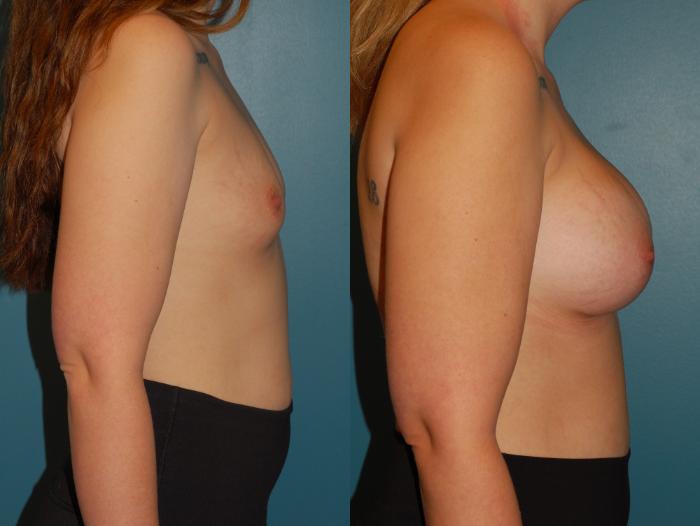 Before & After Breast Augmentation Case 68 View #5 View in Ellicott City, MD