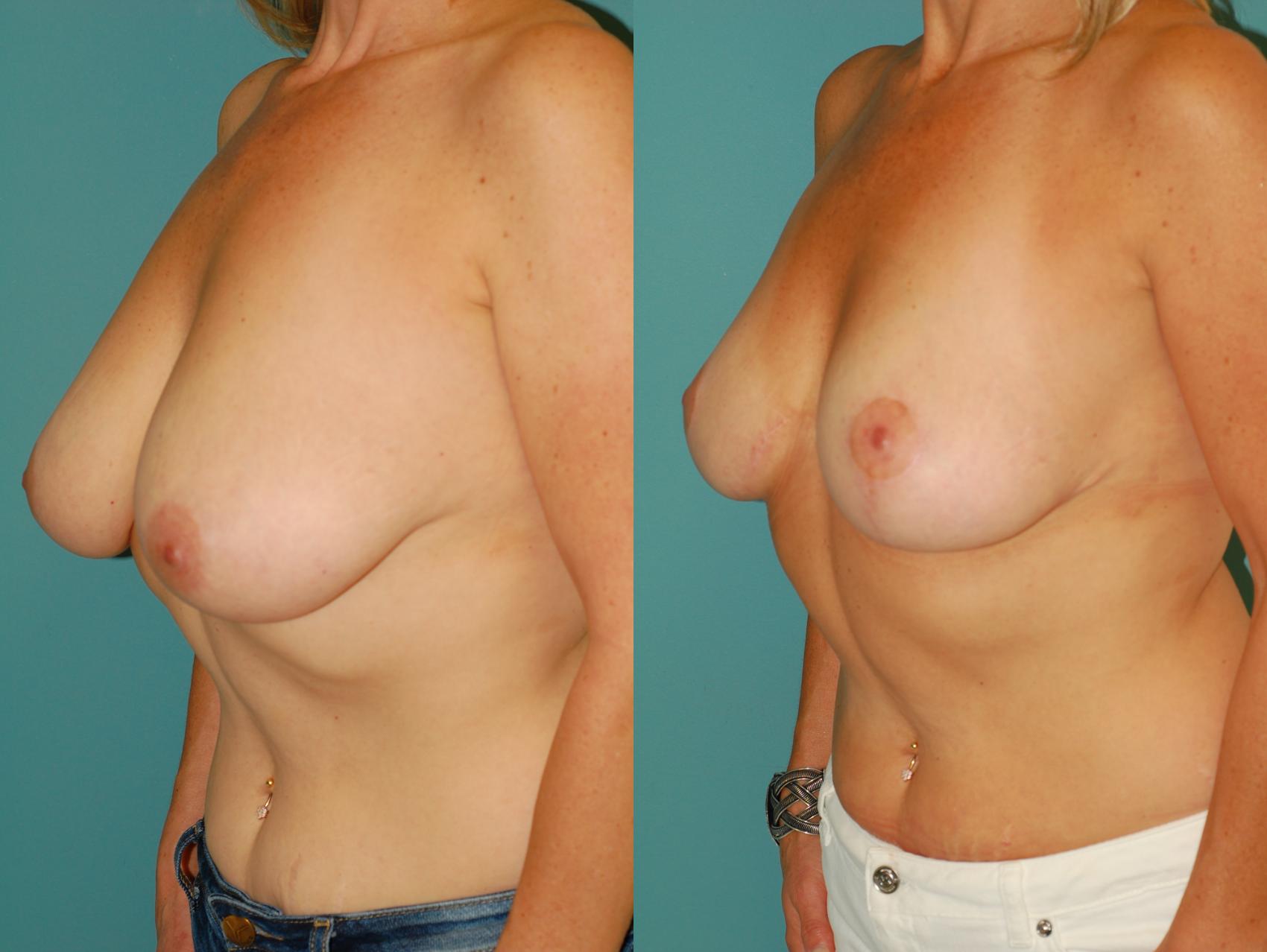 Before & After Breast Lift without Implants Case 56 View #2 View in Ellicott City, MD