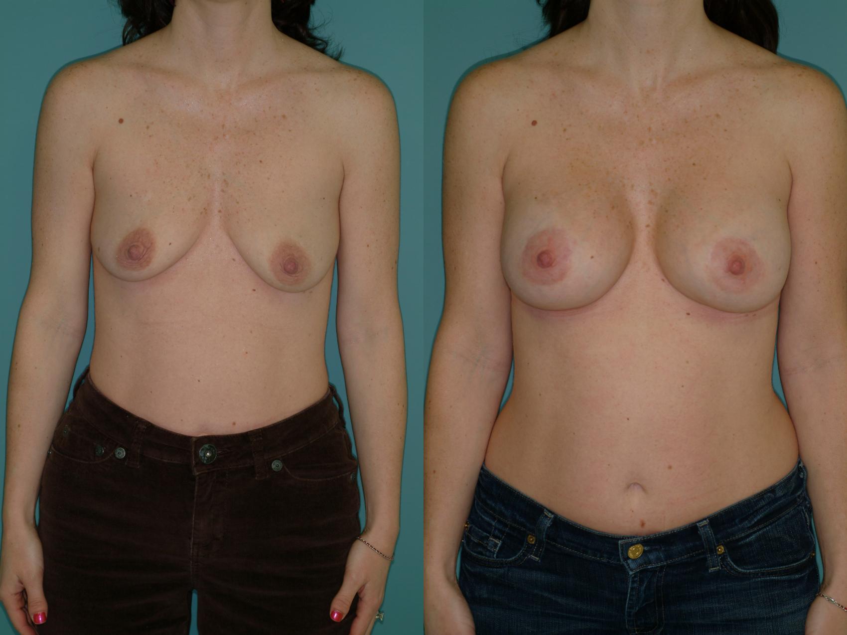 Before & After Crescent Breast Lift with Implants Case 29 View #1 View in Ellicott City, MD