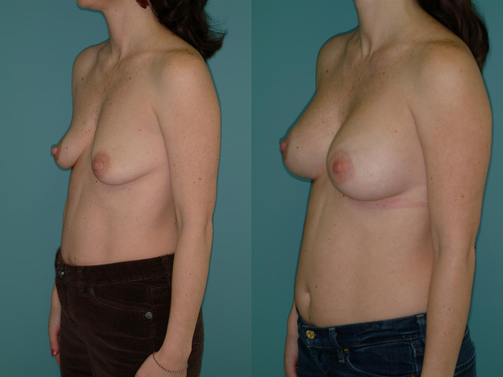Before & After Crescent Breast Lift with Implants Case 29 View #2 View in Ellicott City, MD