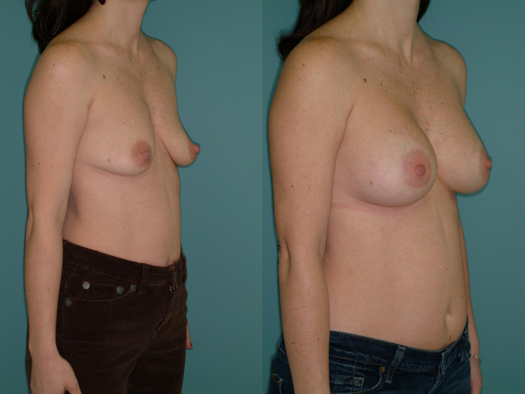 Before & After Crescent Breast Lift with Implants Case 29 View #3 View in Ellicott City, MD