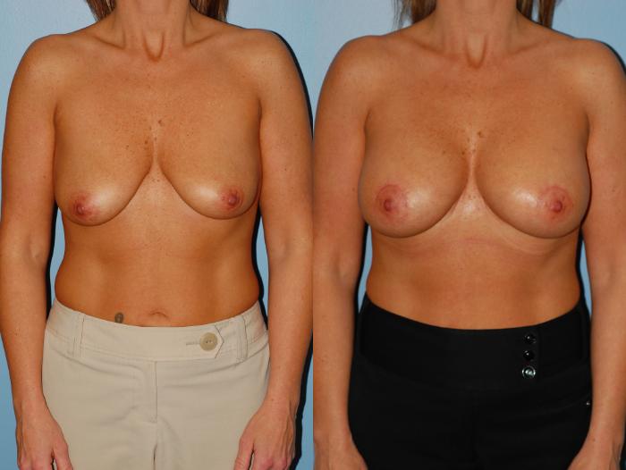 Before & After Crescent Breast Lift with Implants Case 30 View #1 View in Ellicott City, MD
