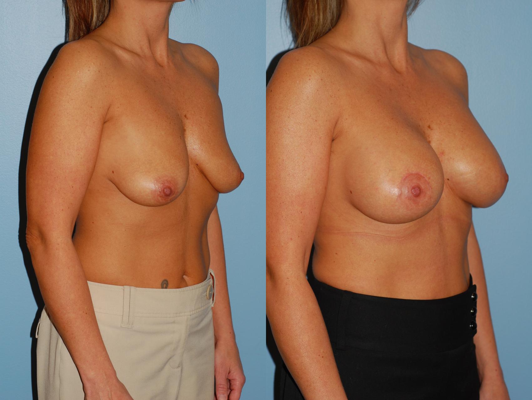 Before & After Crescent Breast Lift with Implants Case 30 View #2 View in Ellicott City, MD