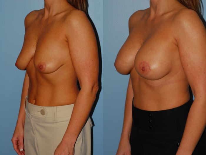 Before & After Crescent Breast Lift with Implants Case 30 View #3 View in Ellicott City, MD