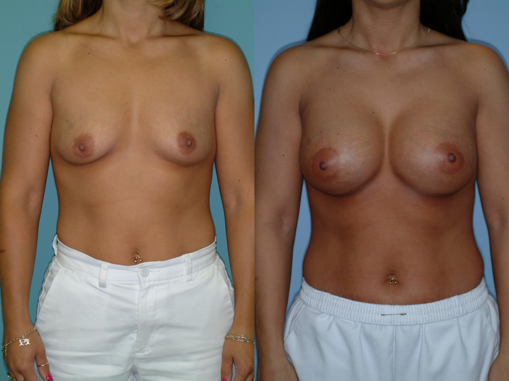 Before & After Crescent Breast Lift with Implants Case 31 View #1 View in Ellicott City, MD