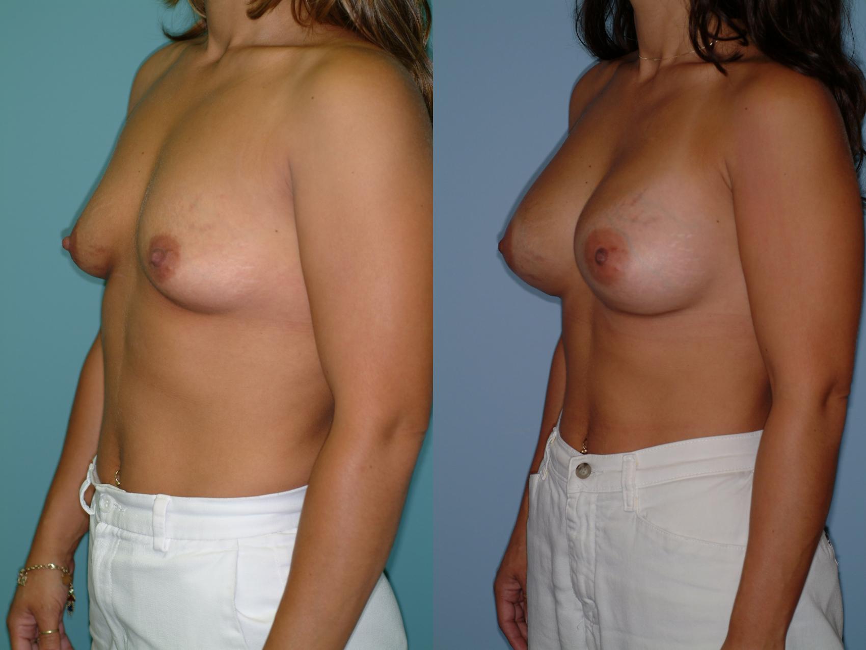 Before & After Crescent Breast Lift with Implants Case 31 View #2 View in Ellicott City, MD