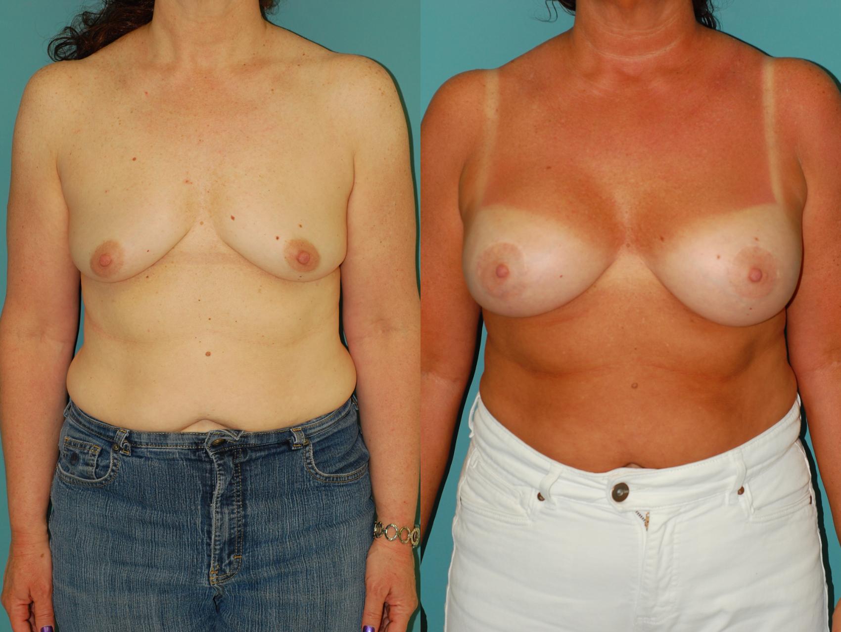 Before & After Crescent Breast Lift with Implants Case 32 View #1 View in Ellicott City, MD