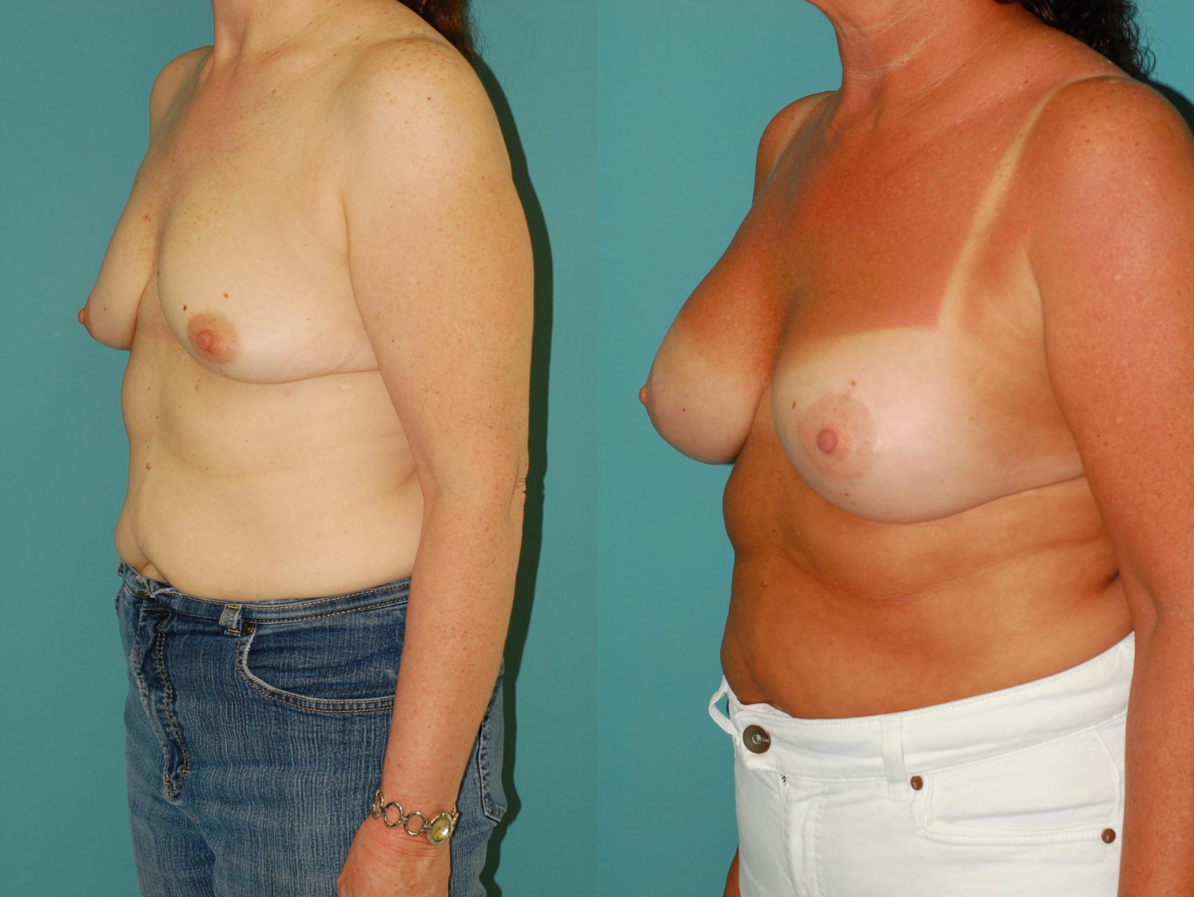 Before & After Crescent Breast Lift with Implants Case 32 View #2 View in Ellicott City, MD