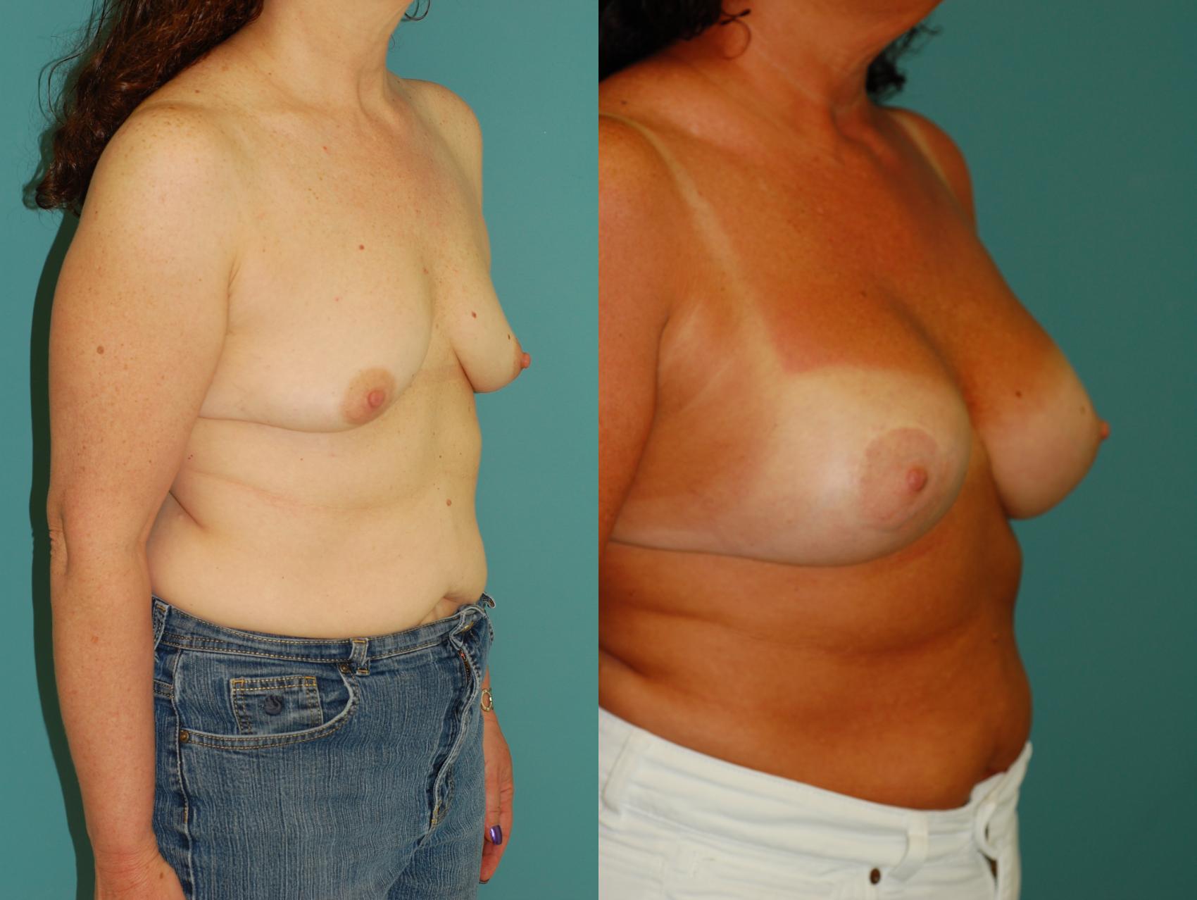 Before & After Crescent Breast Lift with Implants Case 32 View #3 View in Ellicott City, MD