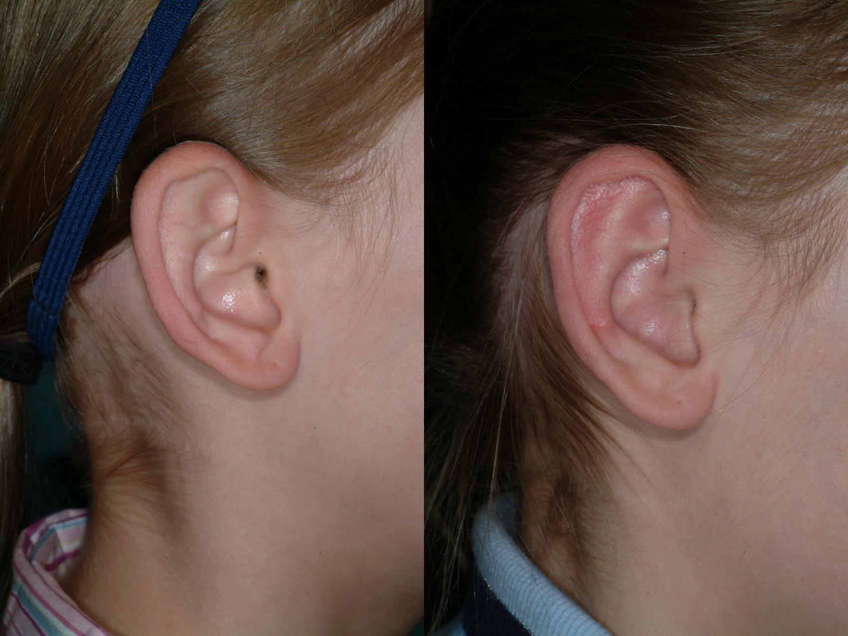 Before & After Ear Surgery Case 18 View #3 View in Ellicott City, MD