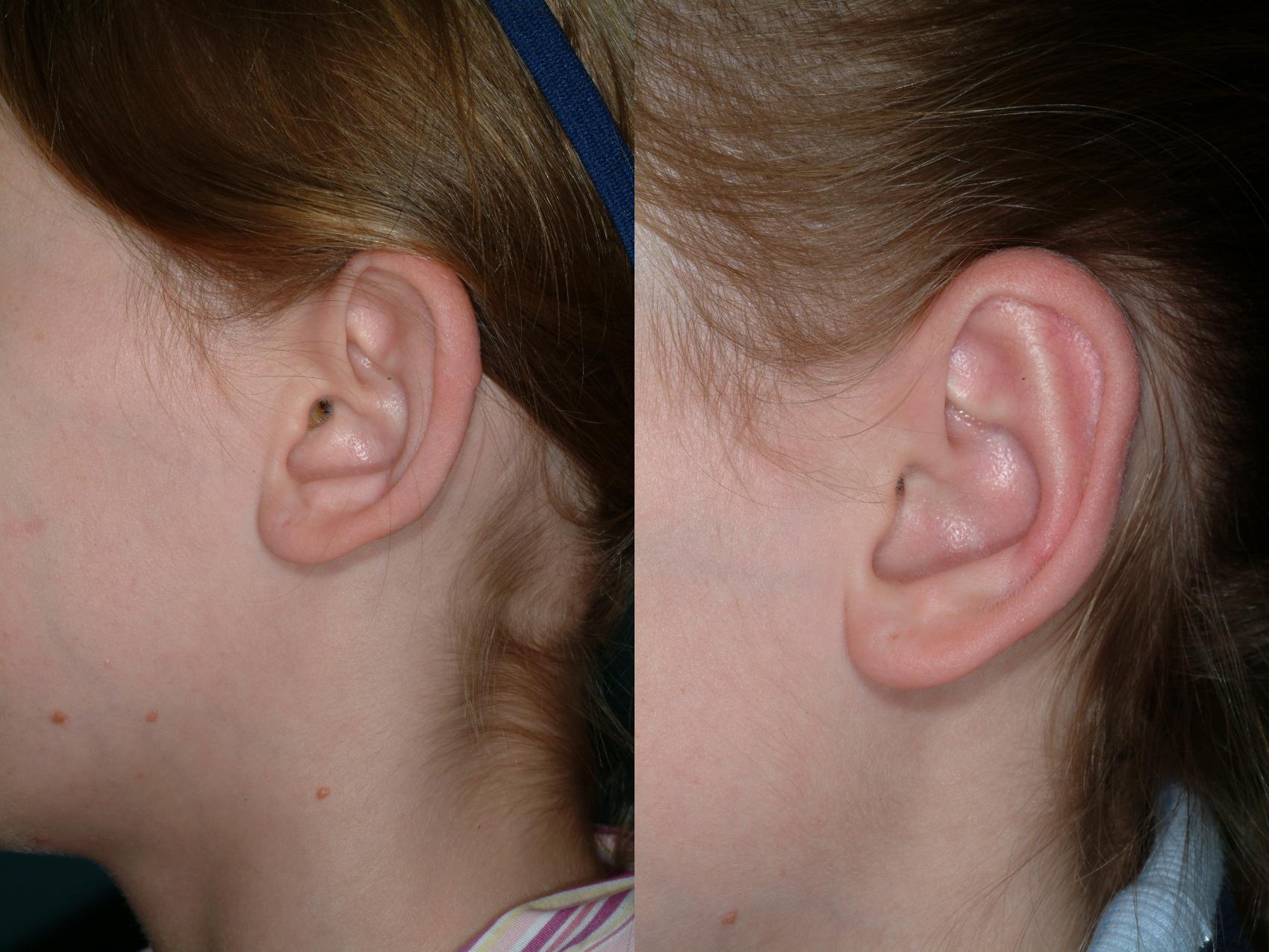 Before & After Ear Surgery Case 18 View #4 View in Ellicott City, MD