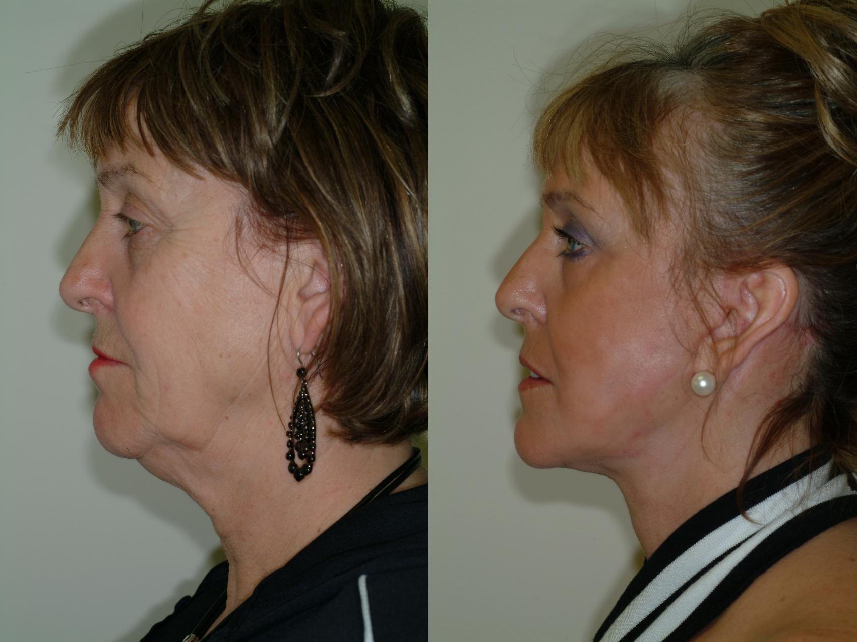 Facial Plastic Surgery, Bandage after a laser face lift and