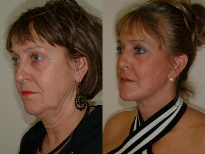 Before & After Face Lift Case 4 View #2 View in Ellicott City, MD