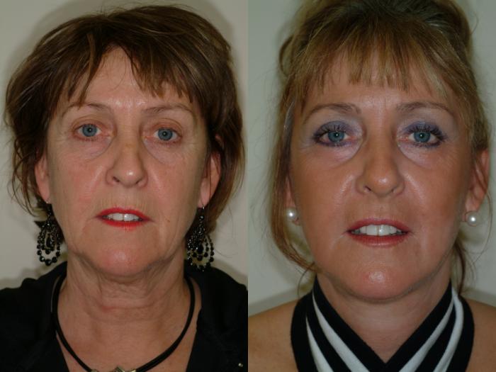 Before & After Face Lift Case 4 View #3 View in Ellicott City, MD