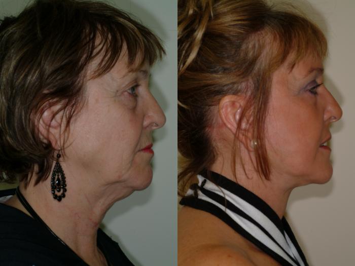 Before & After Upper Eyelid Surgery Case 4 View #4 View in Ellicott City, MD