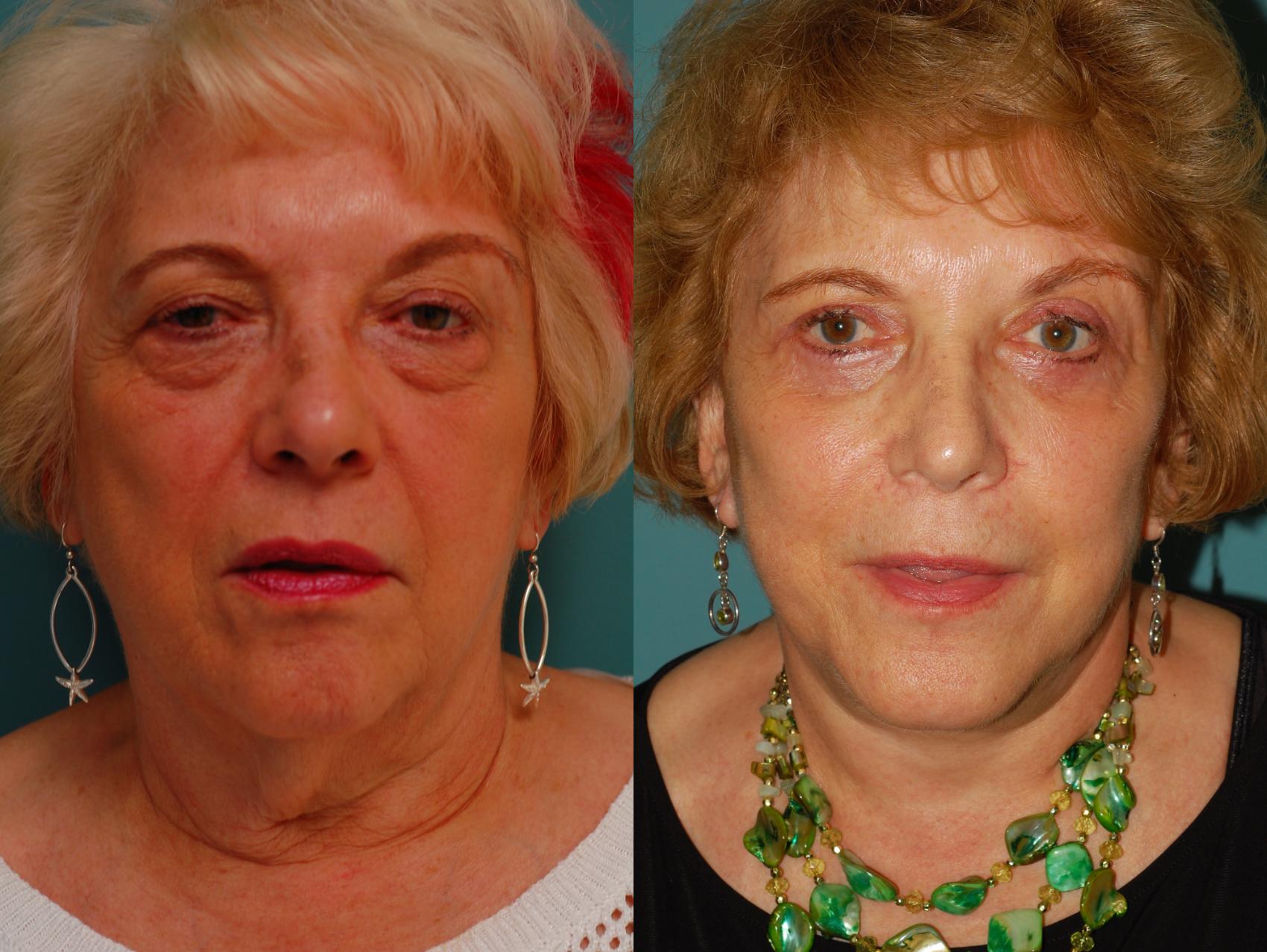Before & After Upper Eyelid Surgery Case 47 View #1 View in Ellicott City, MD