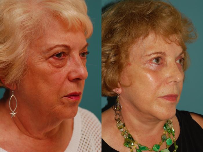 Before & After Lower Eyelid Surgery Case 47 View #2 View in Ellicott City, MD