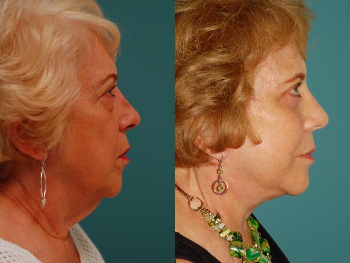 Before & After Lower Eyelid Surgery Case 47 View #3 View in Ellicott City, MD