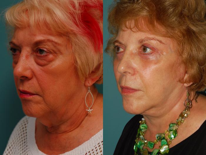 Before & After Lower Eyelid Surgery Case 47 View #4 View in Ellicott City, MD