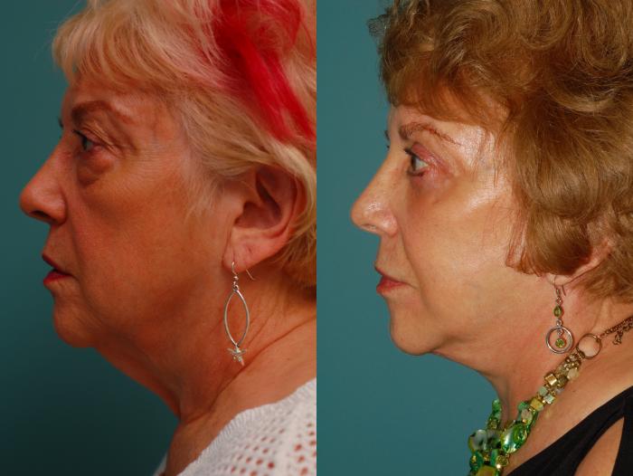 Before & After Upper Eyelid Surgery Case 47 View #5 View in Ellicott City, MD