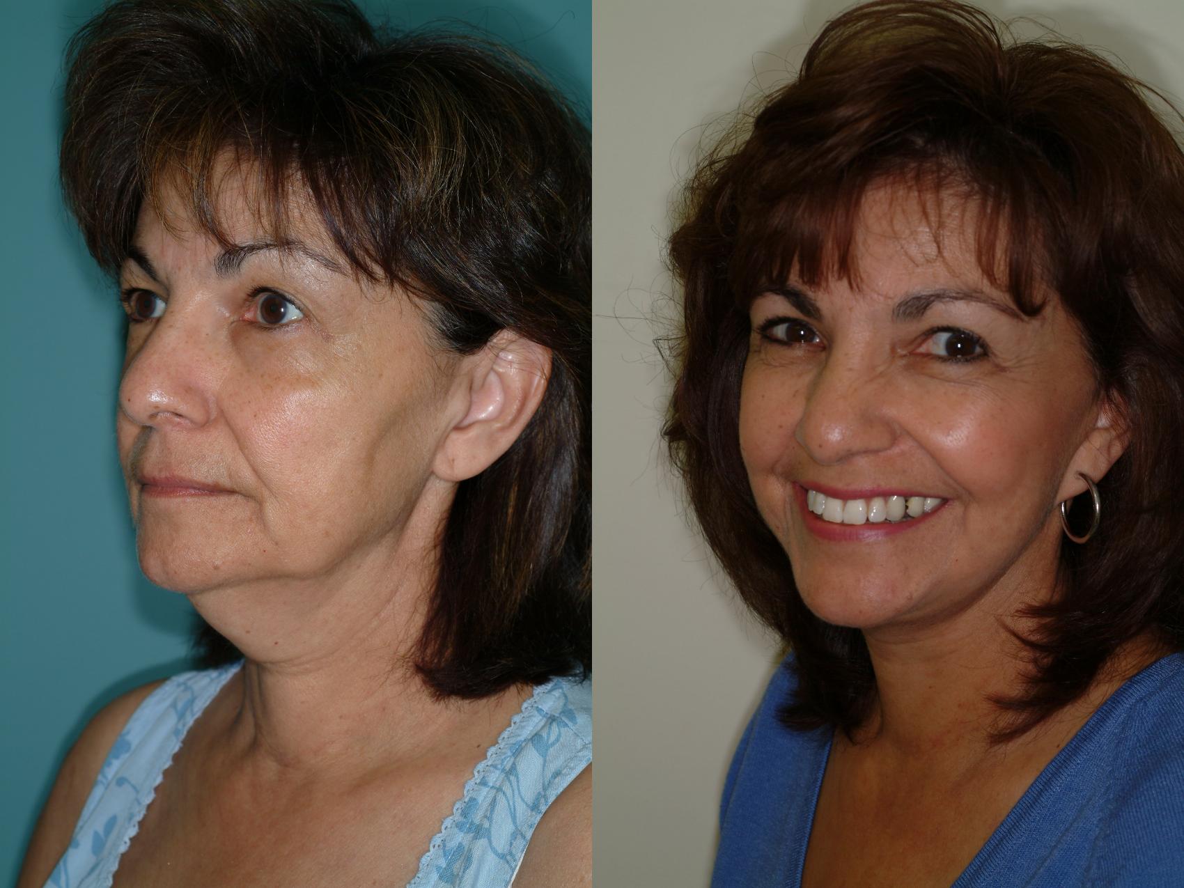 Before & After Upper Eyelid Surgery Case 7 View #1 View in Ellicott City, MD