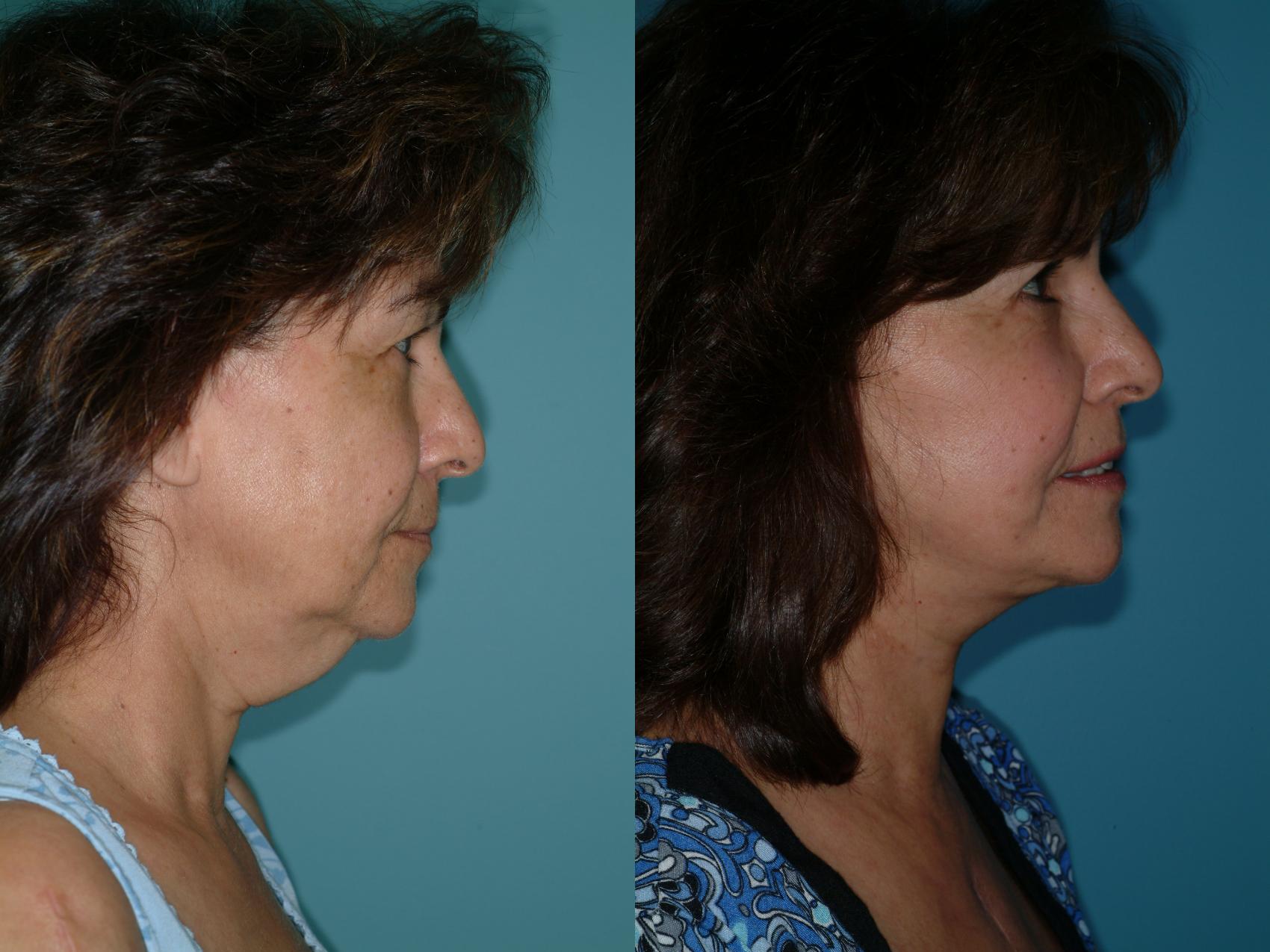 Before & After Face Lift Case 7 View #3 View in Ellicott City, MD