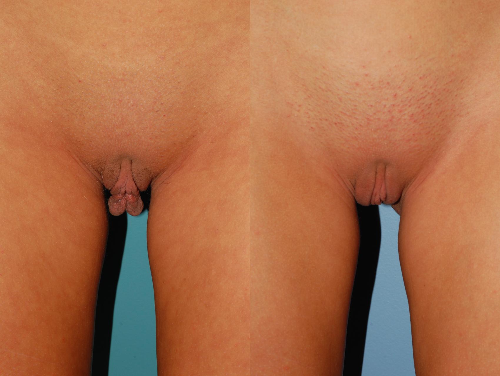Before & After Labiaplasty Case 60 View #1 View in Ellicott City, MD