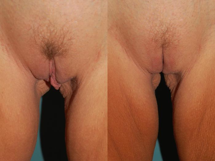 Before & After Labiaplasty Case 62 View #1 View in Ellicott City, MD