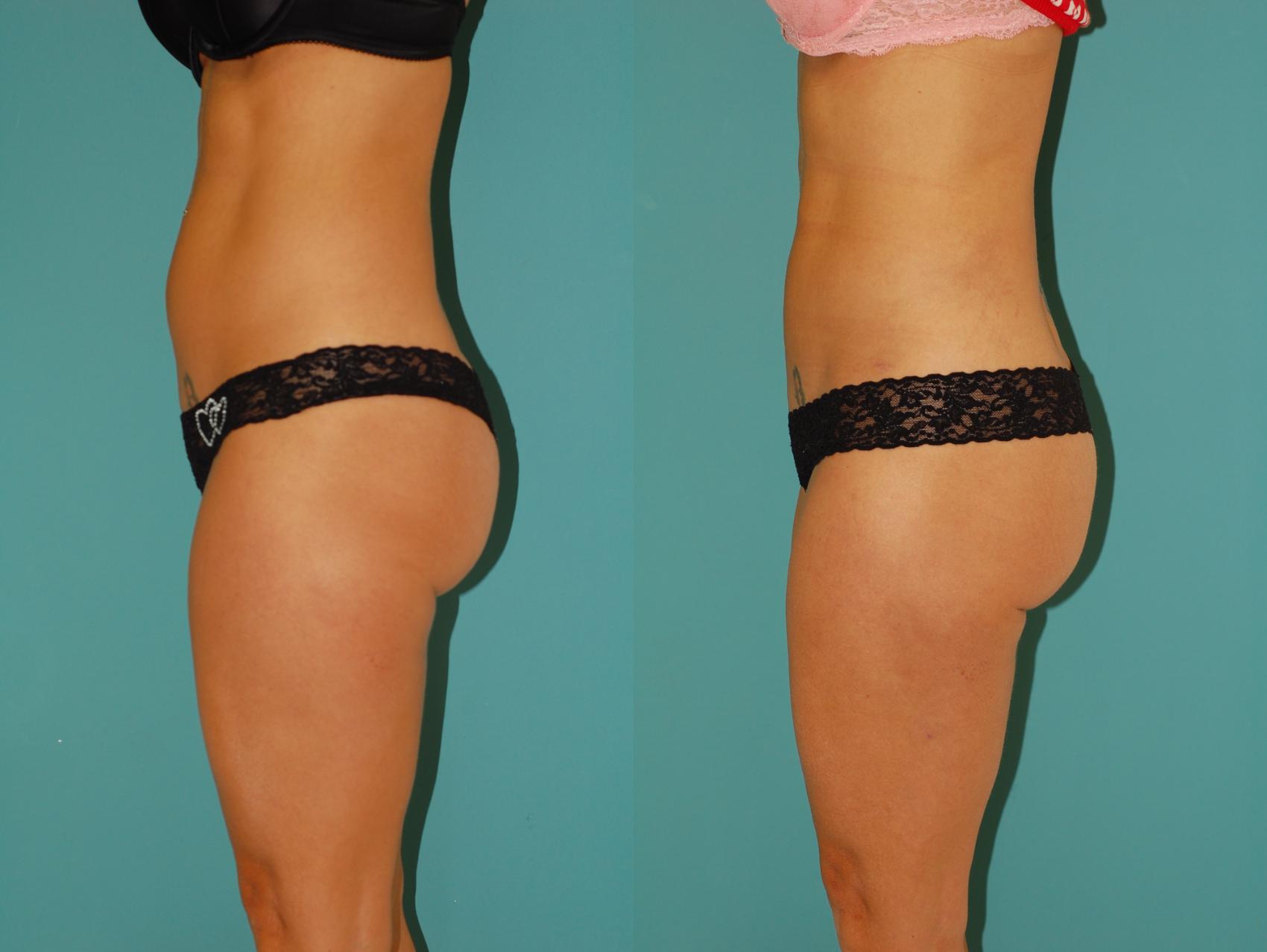 Before & After Liposuction Case 33 View #1 View in Ellicott City, MD