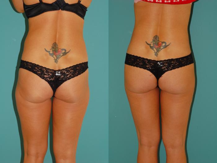 Before & After Liposuction Case 33 View #2 View in Ellicott City, MD