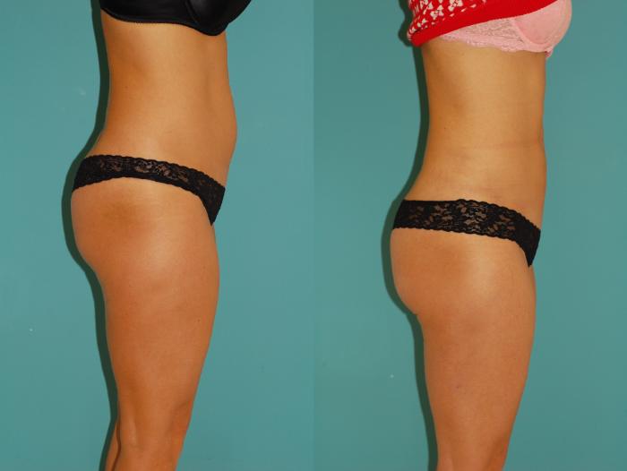 Before & After Liposuction Case 33 View #3 View in Ellicott City, MD