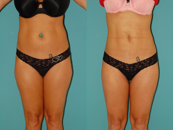 Before & After Liposuction Case 33 View #4 View in Ellicott City, MD