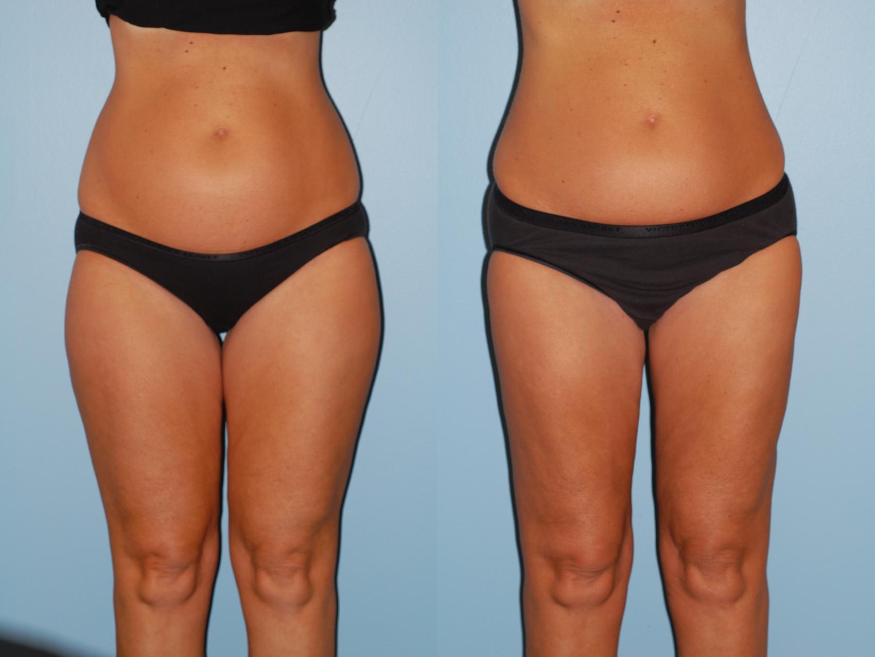 Before & After Liposuction Case 34 View #1 View in Ellicott City, MD