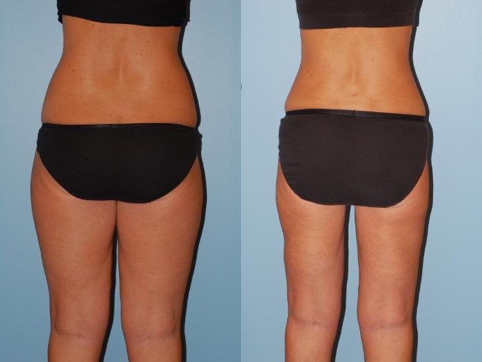 Before & After Liposuction Case 34 View #2 View in Ellicott City, MD