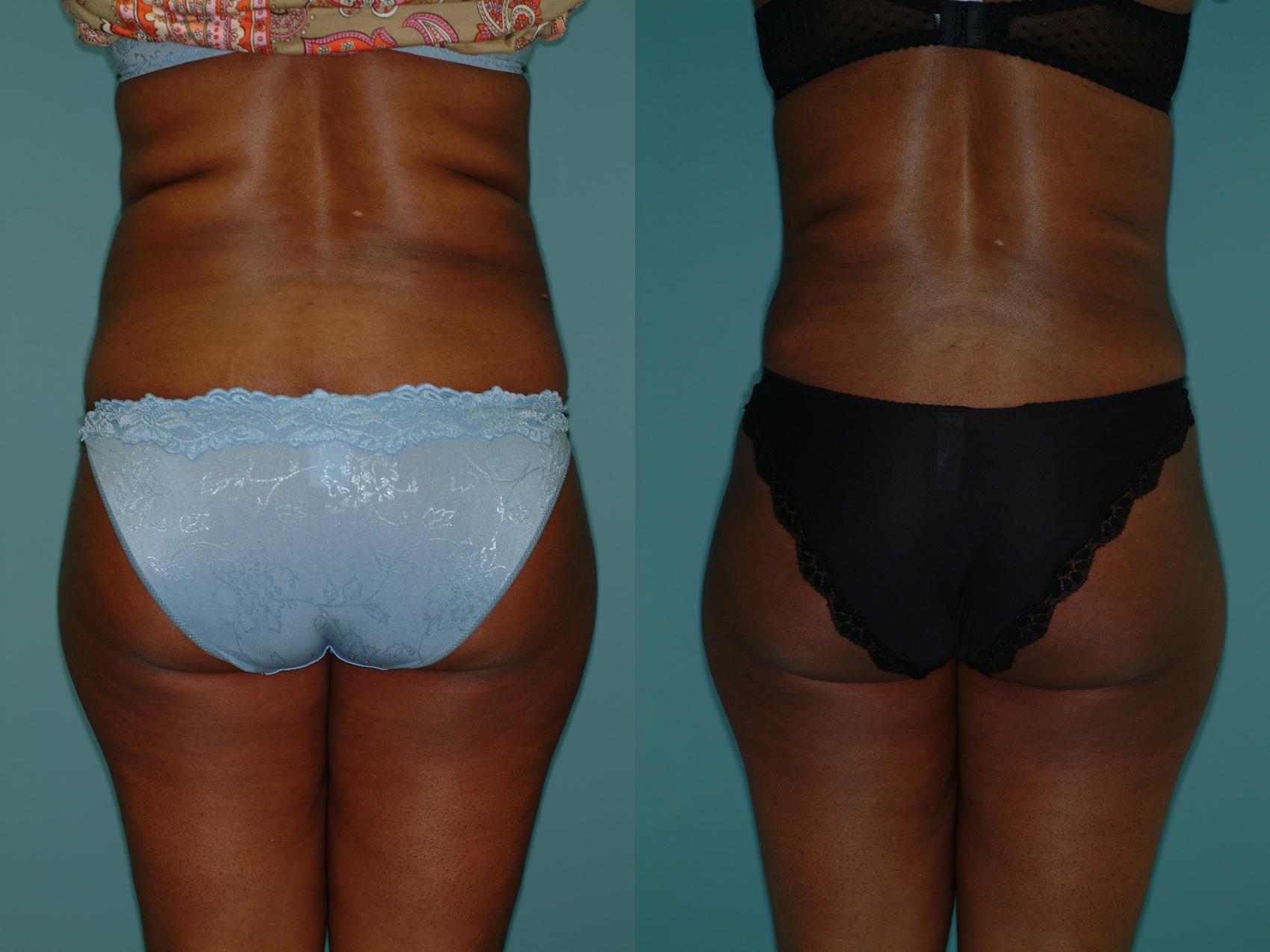 Before & After Liposuction Case 35 View #1 View in Ellicott City, MD