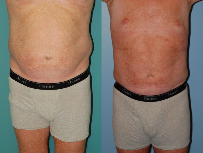 Before & After Liposuction Case 36 View #1 View in Ellicott City, MD